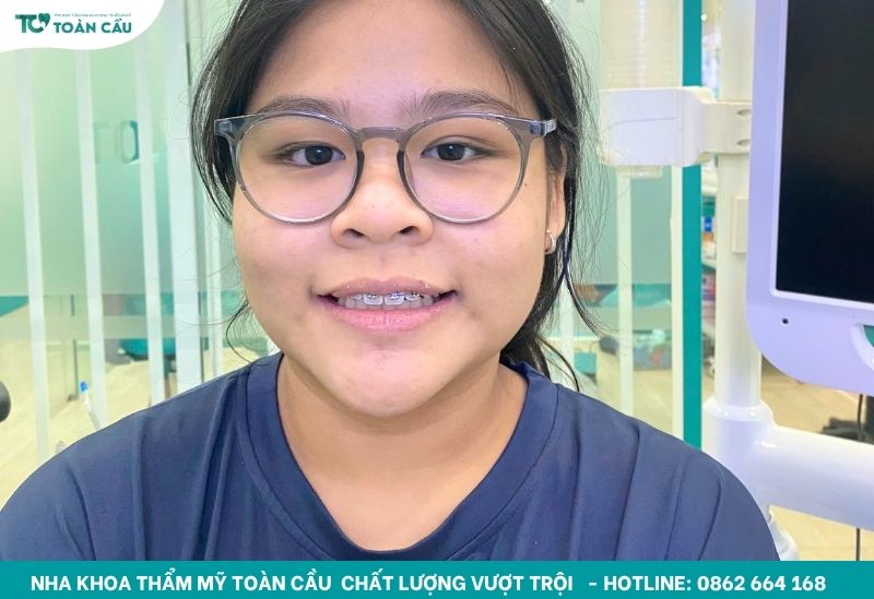 Giải pháp niềng răng trả góp cho sinh viên chỉ từ 1 triệu đồng 8 Khách hàng niềng răng tại Toàn Cầu
