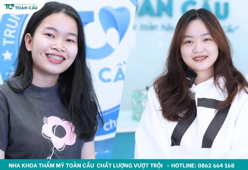 Niềng răng mắc cài kim loại