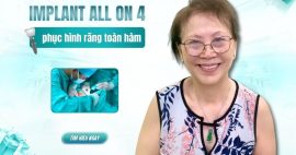 phục hình toàn hàm bằng implant All on 4
