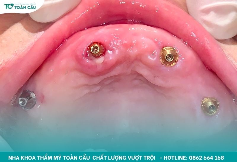 Phục hình toàn hàm bằng implant All on 4