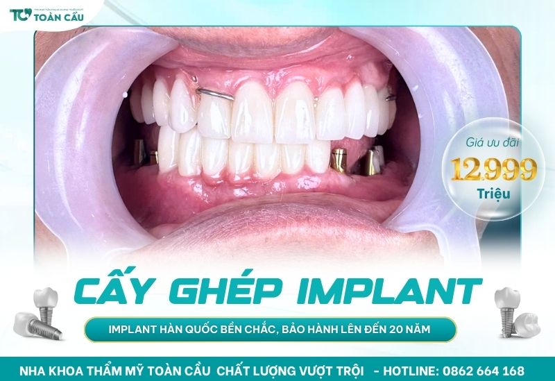 Cấy ghép Implant trọn gói chỉ 12.999.000 đồng