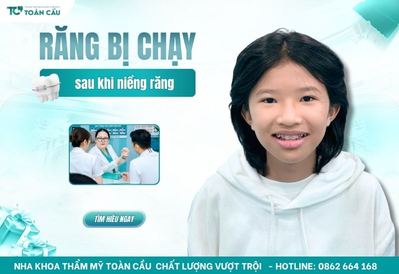 răng bị chạy sau khi niềng