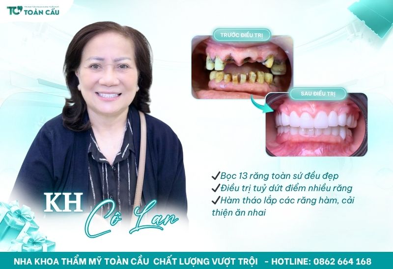 Răng bọc sứ lâu năm bị đau nhức là tình trạng phổ biến