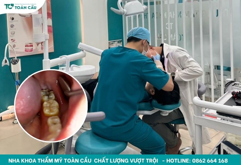 Cách xử lý khi răng hàm bị sâu đen gây đau nhức kéo dài 5 Răng hàm bị sâu đen
