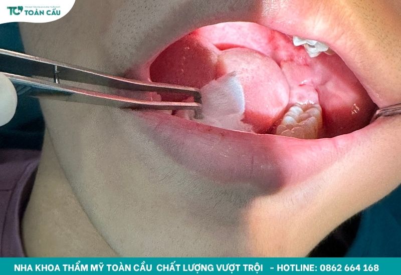 Cách xử lý khi răng hàm bị sâu đen gây đau nhức kéo dài 7 Nhổ răng khắc phục răng sâu