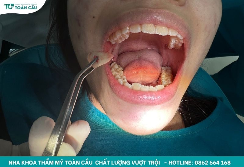 Cách xử lý khi răng hàm bị sâu đen gây đau nhức kéo dài 8 Nhổ răng an toàn cùng Toàn Cầu