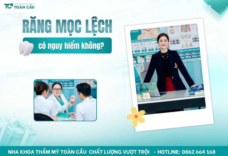răng hàm dưới mọc lệch vào trong