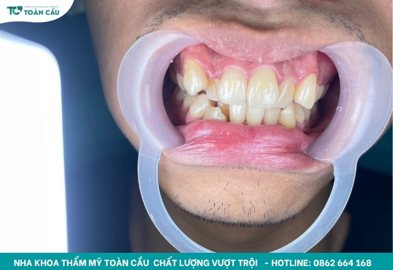 Răng hàm dưới mọc lệch vào trong