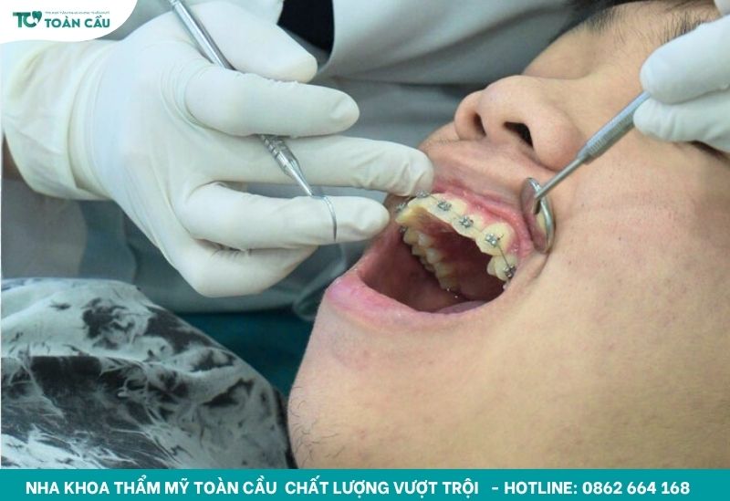 Niềng răng khắc phục tình trạng răng hàm dưới mọc lệch