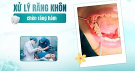 răng khôn chèn răng hàm