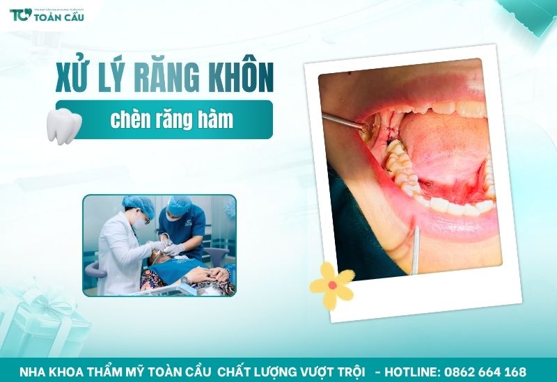 răng khôn chèn răng hàm