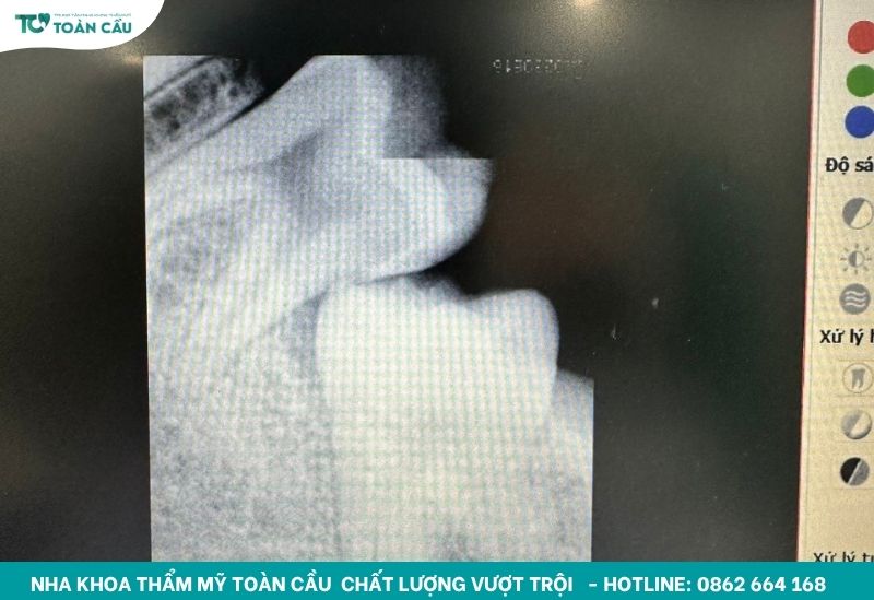 Răng khôn chèn răng hàm là răng khôn mọc lệch