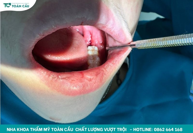 Nha khoa nhổ răng khôn uy tín tại TPHCM