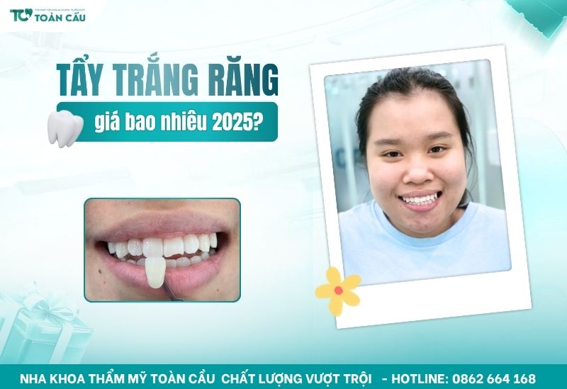 Tẩy trắng răng giá bao nhiêu