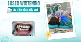 tẩy trắng răng laser
