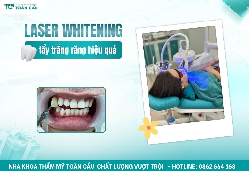 tẩy trắng răng laser