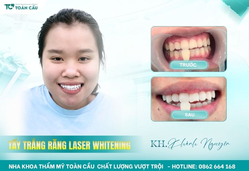 Đánh giá kết quả sau quá trình tẩy trắng