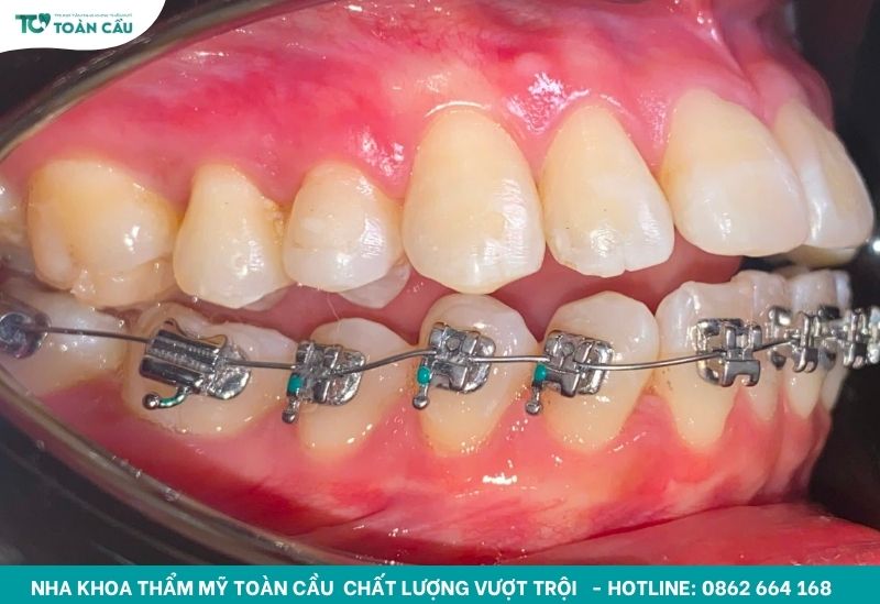 Niềng răng mắc cài