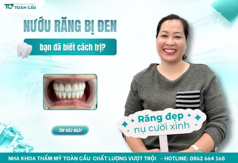 Cách trị nướu răng bị đen