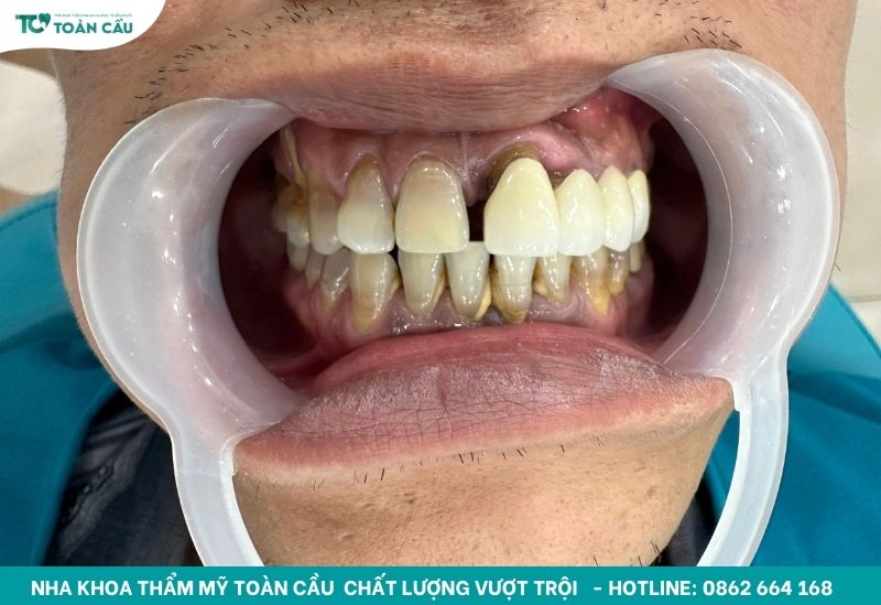 Cách trị nướu răng bị đen đơn giản bạn đã biết chưa? 2 Nướu răng bị đen