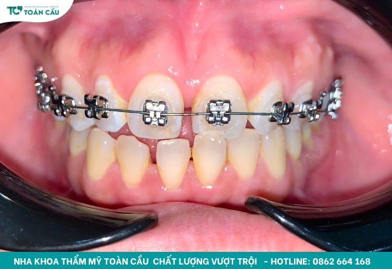 Cách trị nướu răng bị đen đơn giản bạn đã biết chưa? 3 Nướu bị đen do kim loại trong phục hình răng
