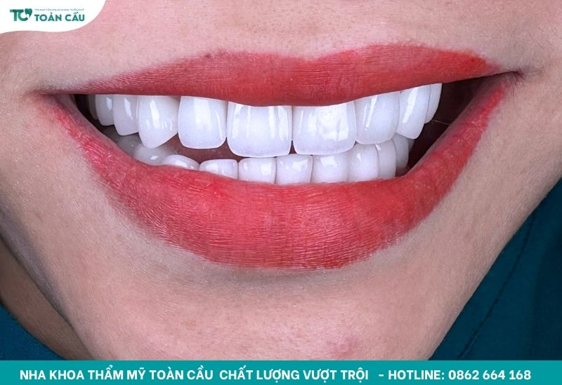 Cách trị nướu răng bị đen đơn giản bạn đã biết chưa? 4 Nụ cười tự tin, thẩm mỹ