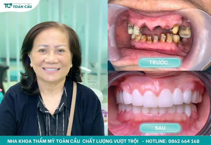 Cách trị nướu răng bị đen đơn giản bạn đã biết chưa? 6 Trước và sau khi bọc răng sứ