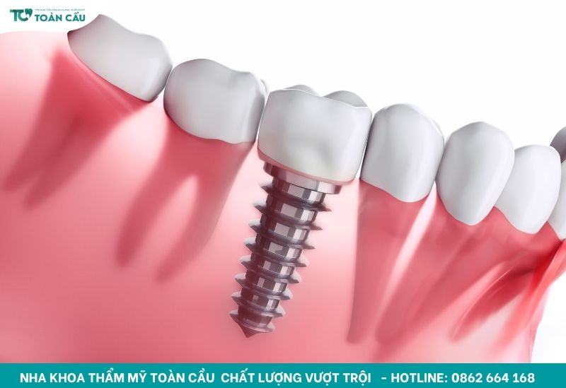 Cấy implant có nguy hiểm không? 10 Rủi ro bạn nên biết 4 Đào thải trụ implant