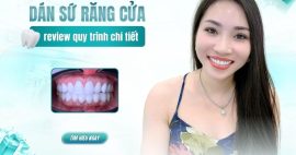 Dán sứ veneer 2 răng cửa