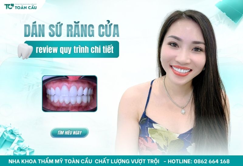 Dán sứ veneer 2 răng cửa