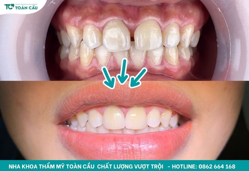 Dán sứ veneer 2 răng cửa