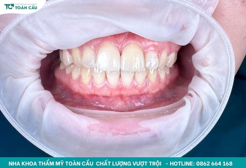 Dán sứ veneer có bị hôi miệng không? Cách phòng ngừa 2 Dán sứ veneer răng cửa