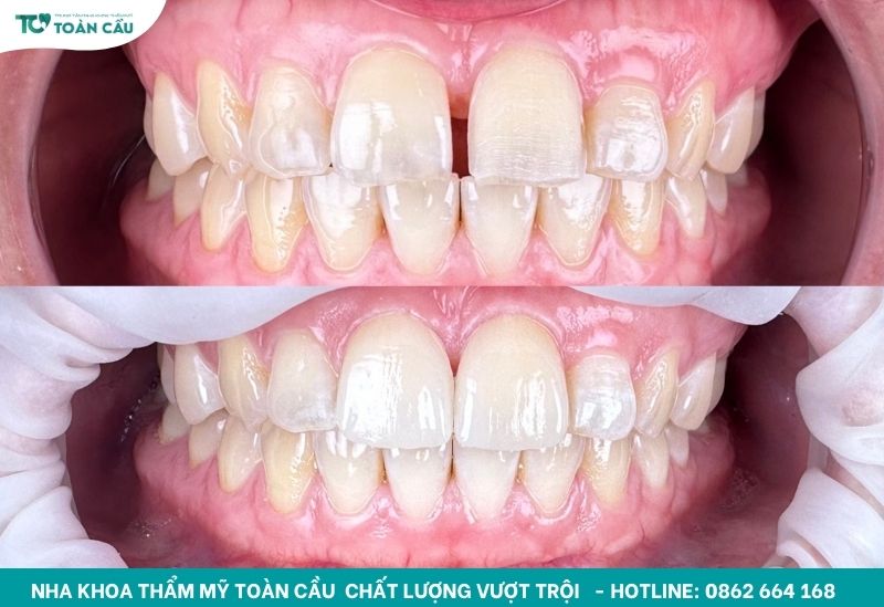 Dán sứ veneer có bị hôi miệng không? Cách phòng ngừa 5 Dán sứ veneer bền và thẩm mỹ