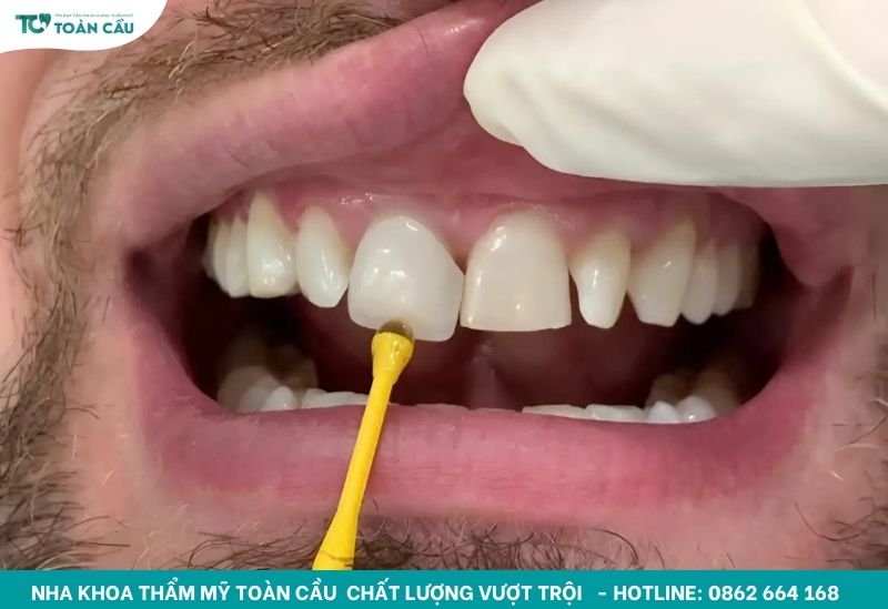 Dán sứ veneer có bị hôi miệng không? Cách phòng ngừa 6 Cận cảnh lắp mặt dán sứ