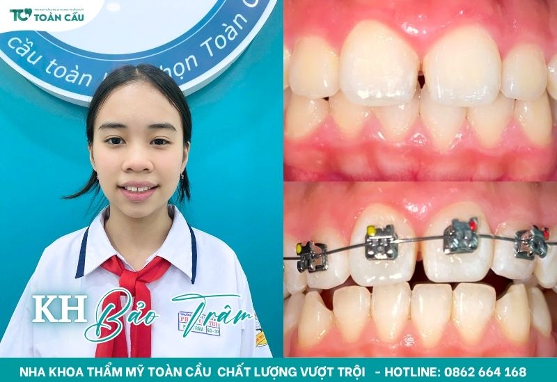 Niềng răng mắc cài tại Nha Khoa Thẩm Mỹ Toàn Cầu