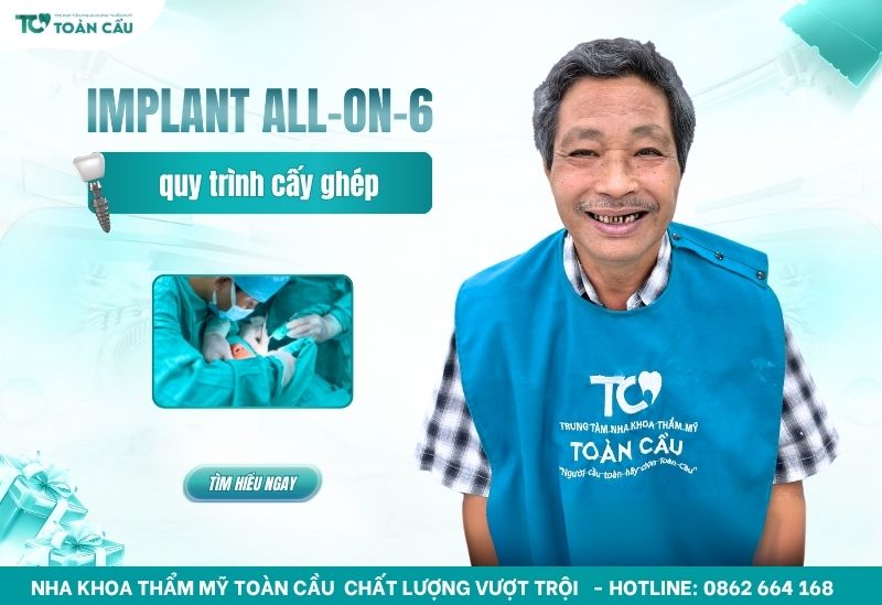 implant All on 6