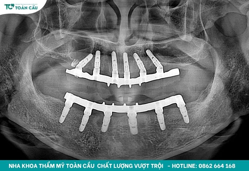Quy trình cấy implant All on 6 và những điều bạn cần biết 5 Implant All on 6