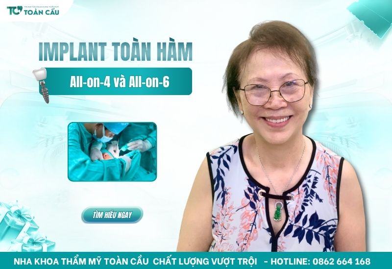 implant toàn hàm