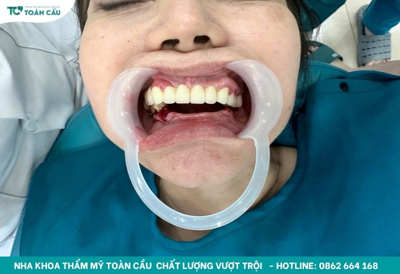 Implant toàn hàm