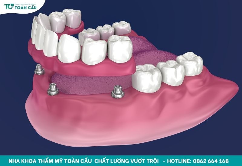Trồng răng implant toàn hàm All-on-4