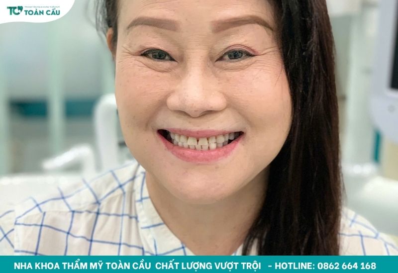 Làm trắng răng bao nhiêu tiền 1 lần? Cập nhật giá mới nhất 4 Khách hàng tẩy trắng răng
