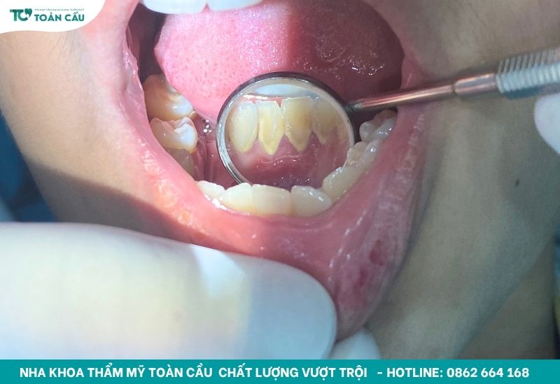 Lấy cao răng hết bao nhiêu tiền? Có nên làm định kỳ không? 3 Lấy cao răng định kỳ