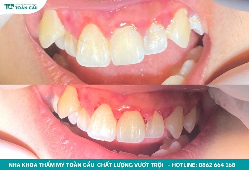 Lấy cao răng hết bao nhiêu tiền? Có nên làm định kỳ không? 5 Hiệu quả lấy cao răng