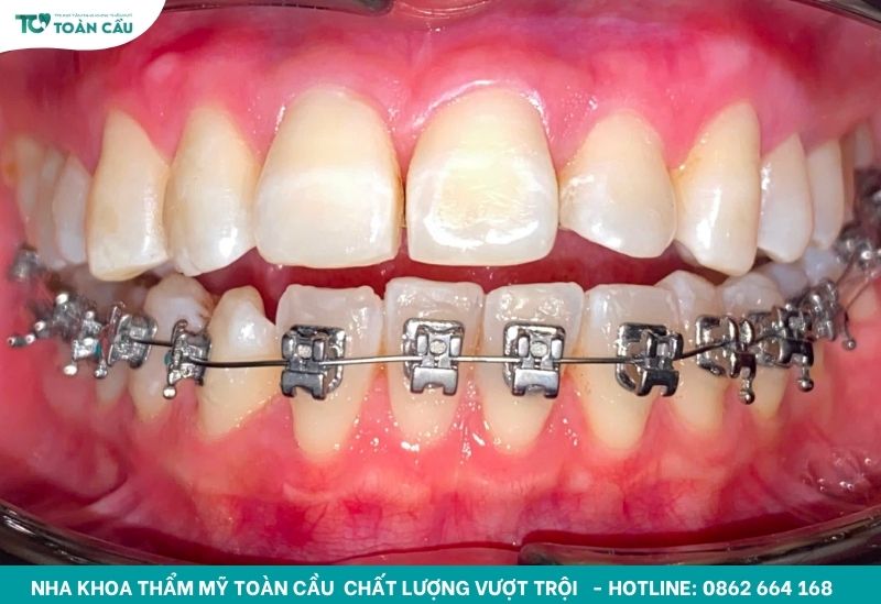 Xu hướng niềng răng mắc cài kim loại tự buộc mới nhất 2025 2 Niềng răng mắc cài kim loại tự buộc