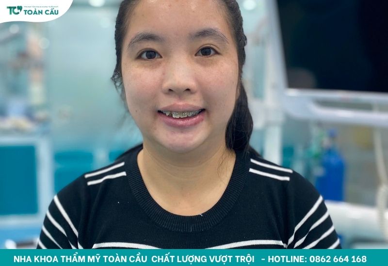 Xu hướng niềng răng mắc cài kim loại tự buộc mới nhất 2025 3 Nâng cao tính thẩm mỹ