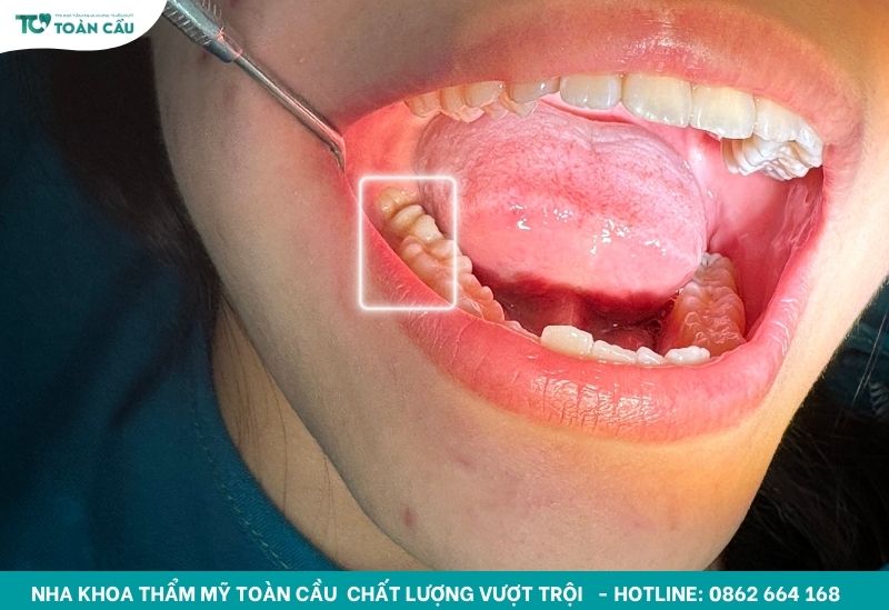 Mọc răng khôn hàm dưới có nguy hiểm không và cách xử lý 2 Răng khôn hàm dưới khó chịu hơn răng trên