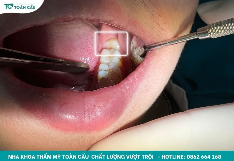 Mọc răng khôn hàm dưới có nguy hiểm không và cách xử lý 3 Răng khôn hàm dưới gây đau nhức kéo dài