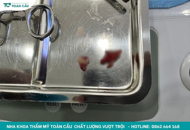 Mọc răng khôn hàm dưới có nguy hiểm không và cách xử lý 5 Nhổ răng khôn an toàn