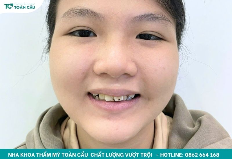 Nắn chỉnh mặt lệch TPHCM giá bao nhiêu, có đắt không? 2 Mặt lệch nhẹ cũng có thể khiến bạn cảm thấy tự ti