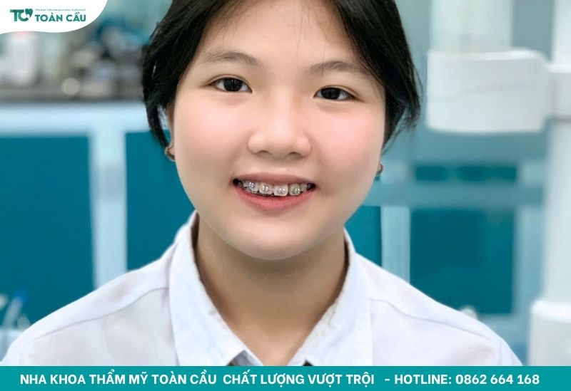 Nắn chỉnh mặt lệch TPHCM giá bao nhiêu, có đắt không? 4 Niềng răng hỗ trợ chỉnh mặt lệch